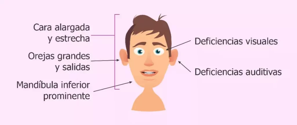 caracteristicas faciales sindrome SXF