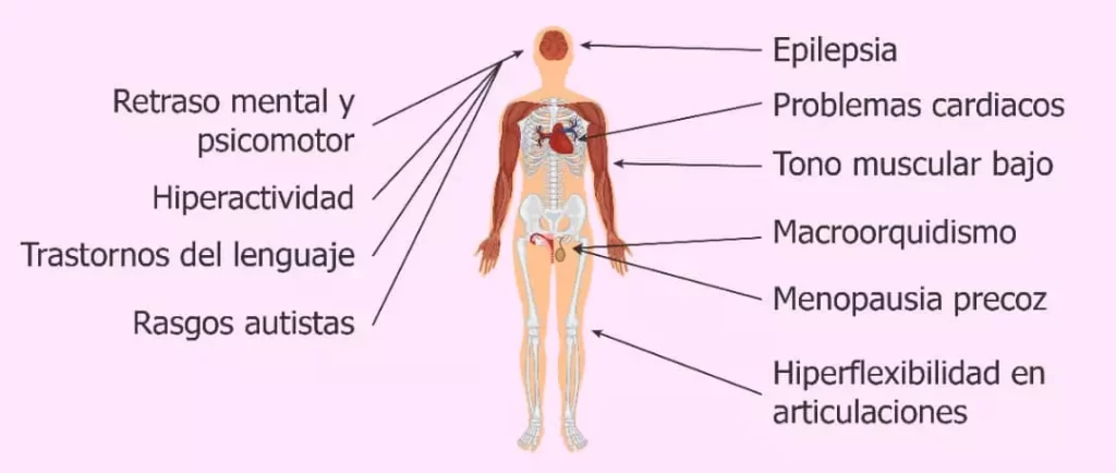 caracteristicas generales sindrome SXF